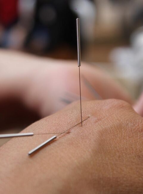 acupuncture, needles, hand-6324472.jpg